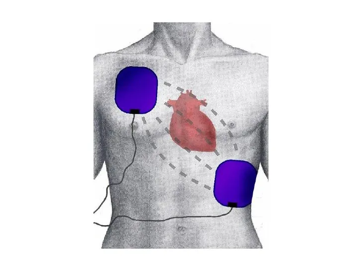 AED Pads Placement