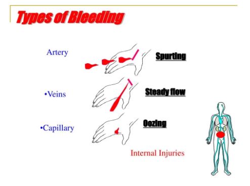 TypesOfBleeds