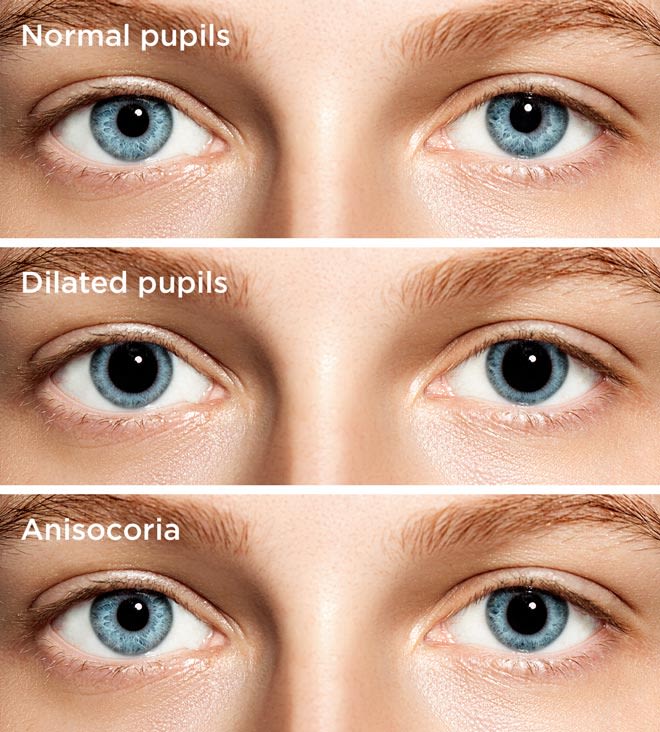 Differences in pupil appearances